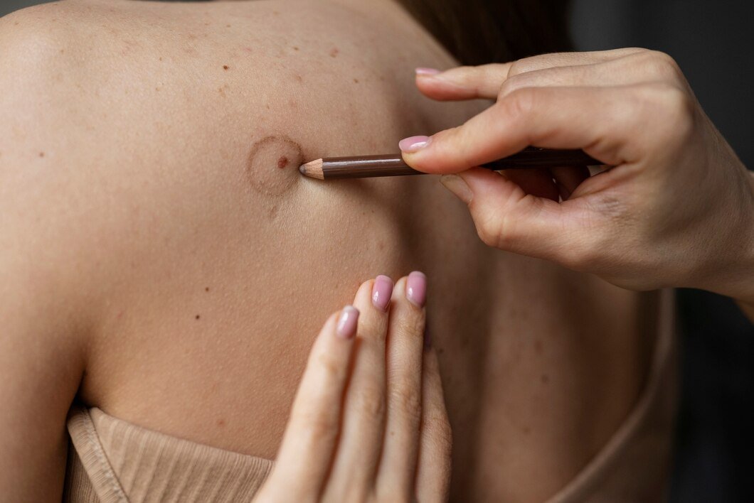 Mole & Skin Tag Removal Image
