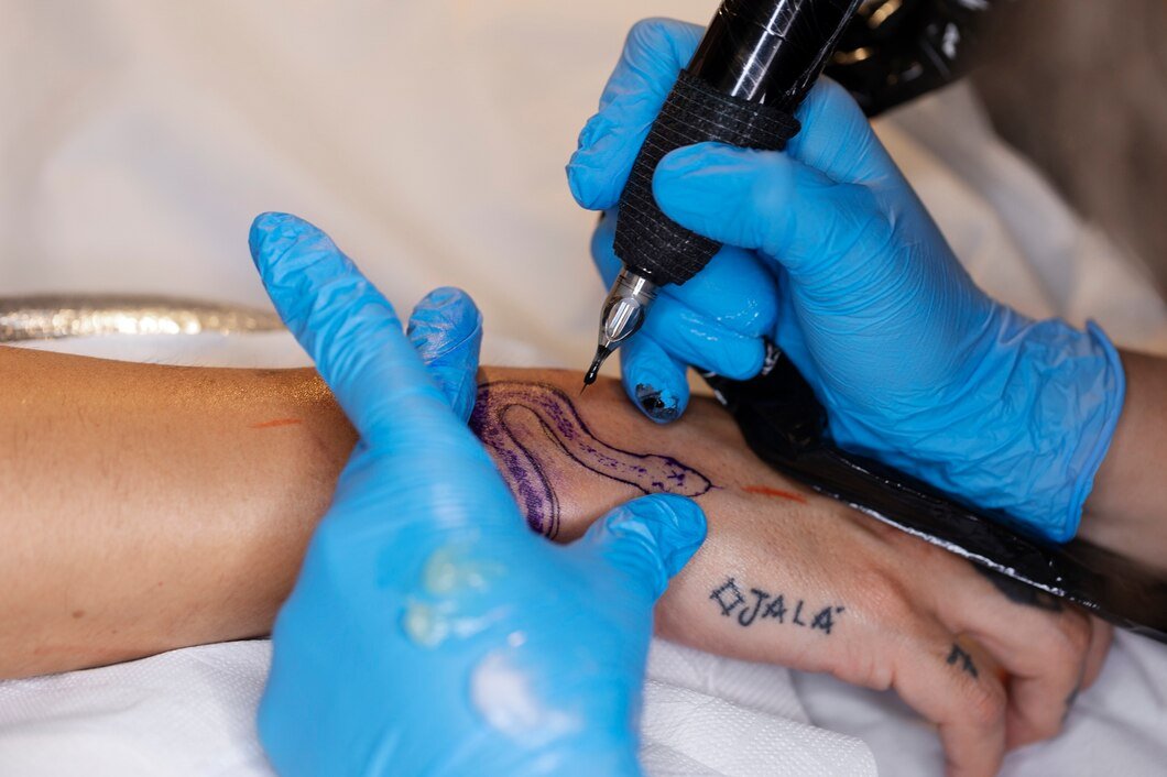 Tattoo Removal Image