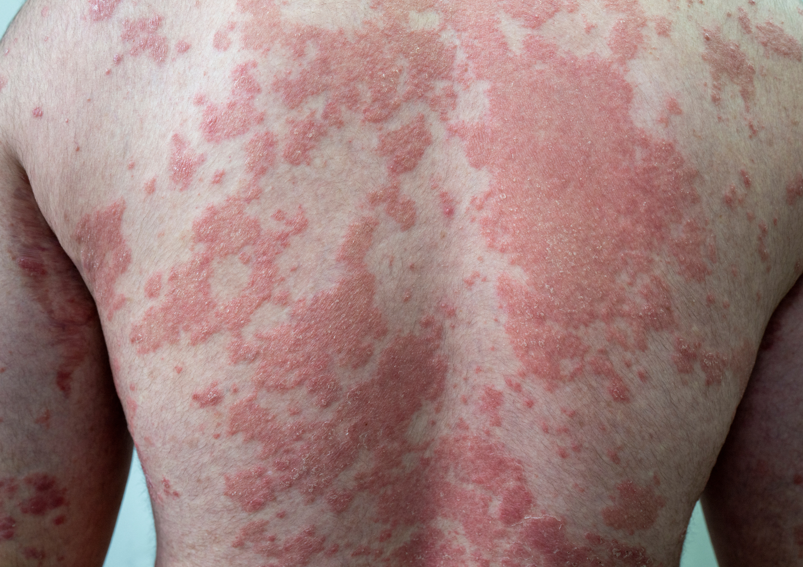 Psoriasis Treatment Image