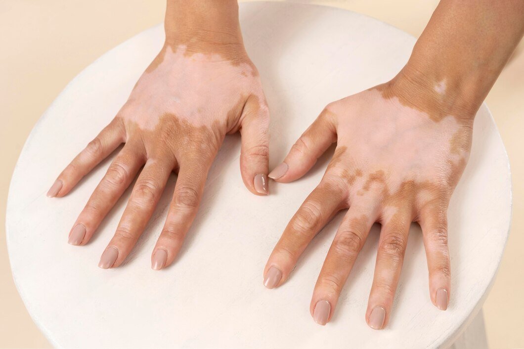 Vitiligo Treatment Image